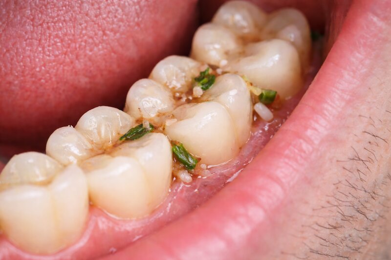 cặn thức ăn - mảng bám