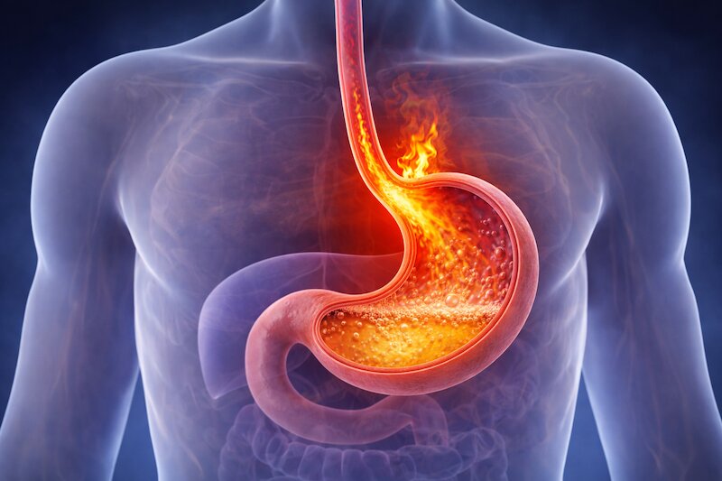 hôi miệng dạ dày do GERD