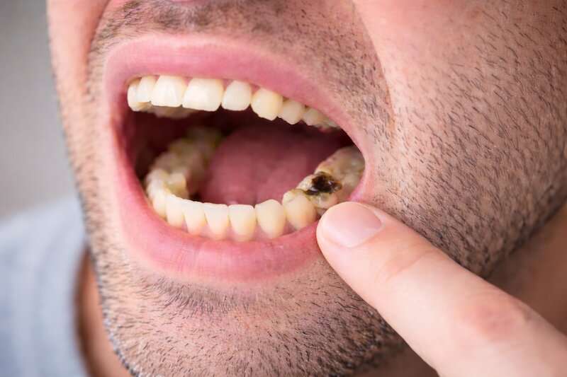 hôi miệng do sâu răng