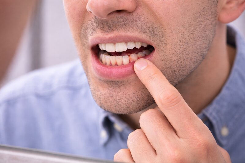 chảy máu chân răng