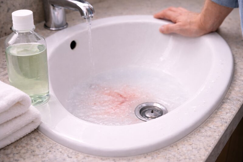 hôi miệng chảy máu chân răng