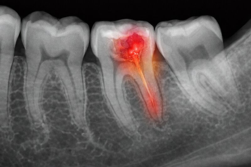hôi miệng do răng bị viêm tuỷ